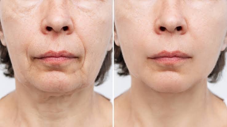 Facelift